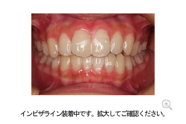 透明なマウスピースでストレスのない矯正をお勧めします。