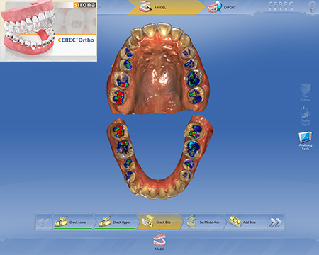 CEREC Ortho を用いた 最先端のインビザライン治療