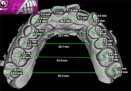 3D Digital Study Models を用いた 最先端のインビザライン治療