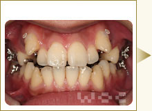 正面から見たリンガル矯正