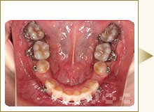下顎のハーフリンガル矯正
