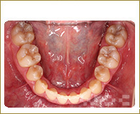 下顎のハーフリンガル矯正
