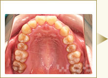 上顎のハーフリンガル矯正