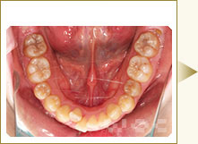 下顎のハーフリンガル矯正
