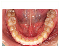 下顎のハーフリンガル矯正