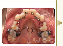 上顎のリンガル矯正