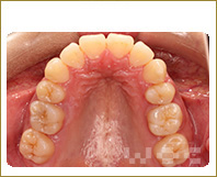 上顎のリンガル矯正