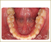 下顎のリンガル矯正