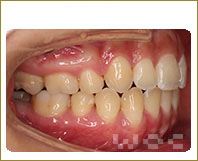 右横のリンガル矯正