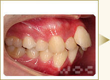 右横のリンガル矯正