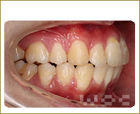 右横のリンガル矯正
