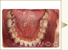 下顎のリンガル矯正
