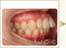 右横のリンガル矯正