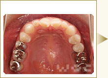上顎のリンガル矯正
