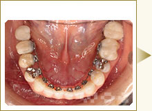 下顎のリンガル矯正