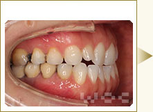 右横のリンガル矯正