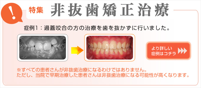 大人の非抜歯矯正：渡辺矯正歯科クリニックで矯正すると大人の方でも歯を抜かずに矯正できる可能性がとても大きいです。