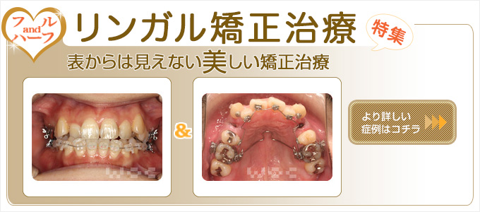 大人の非抜歯矯正：渡辺矯正歯科クリニックでリンガル矯正！表からは見えない美しい矯正治療です。